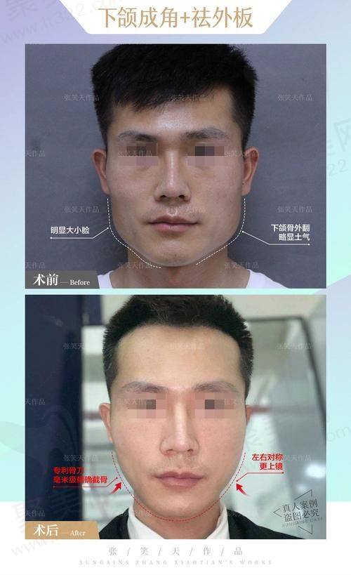 李继华医生擅长哪些手术项目？