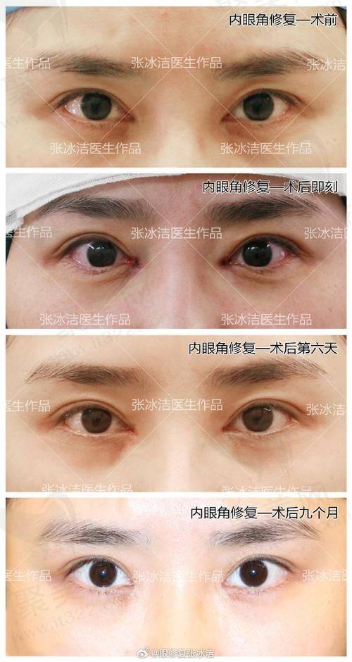 南宁芭芘丽整形芭芘翘睫电眼综合5项包含哪些内容呢？