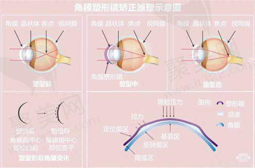 ICL晶体植入手术价格——性价比之选