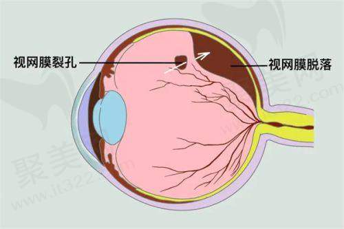 2025东莞不同医院的白内障手术价格