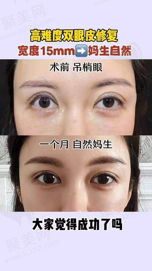 五、选择郑州杨丽美颜医疗美容做双眼皮的建议