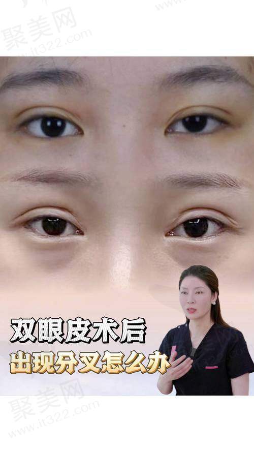 三、郑州杨丽美颜医疗美容的双眼皮技术