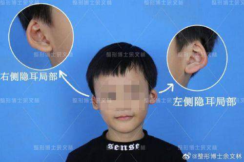 二、东莞人造耳朵哪里做比较好每家医院的详细介绍