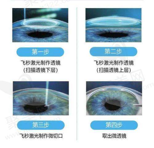西安四院眼科近视手术技术靠谱 - 医生团队