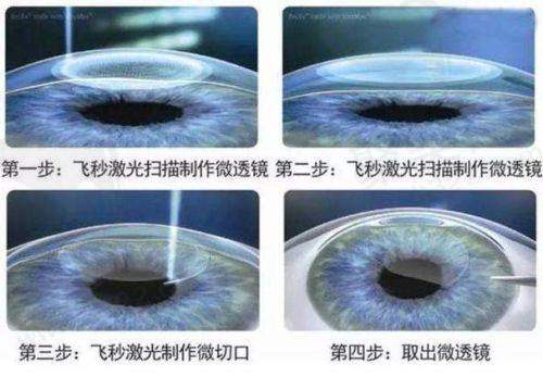 2025西安四院眼科预约流程 & 报销比例