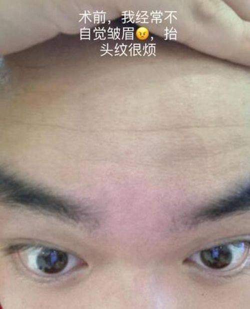 四、影响做抬头纹费用的其他因素