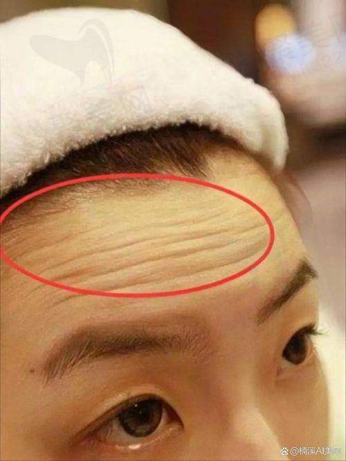 一、做抬头纹费用的总体范围