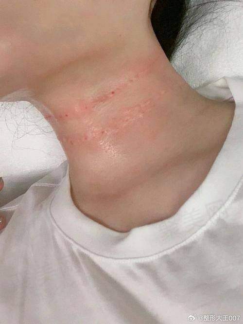 深圳福雅整形嗨体1.5mL去颈纹的作用和成效