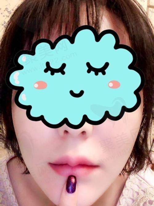 三、陈翠云医生做唇部整形的优势