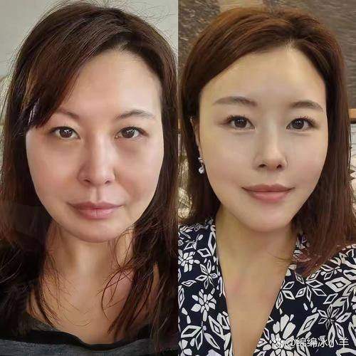 深圳福雅医疗美容小切口拉皮面部提升术的修复过程