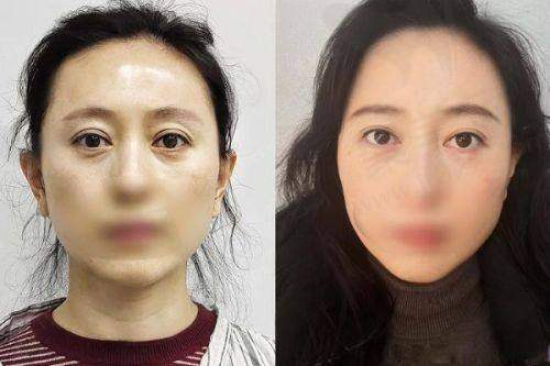 四、何元飞隆胸手术实例
