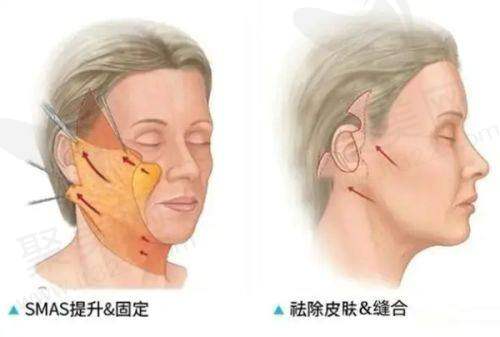 重庆艺星朱家旭自体脂肪面部填充6930元起的优势分析