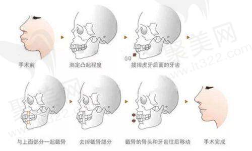 杭州美莱万连壮医生的术后成效和患者评价