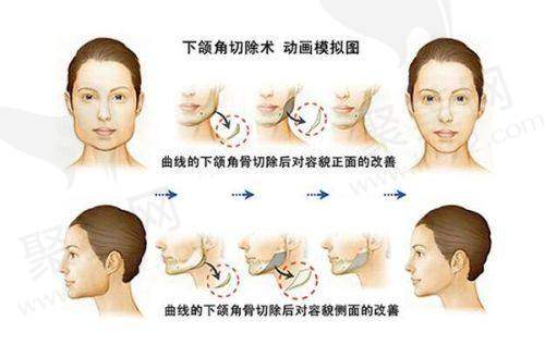 重庆艺星朱家旭自体脂肪面部填充6930元起的技术特点