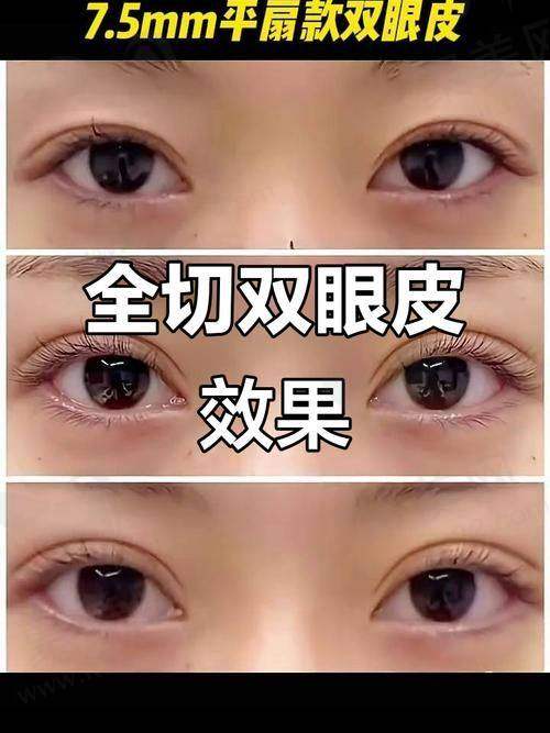 三、逯岩院长双眼皮手术成效实例