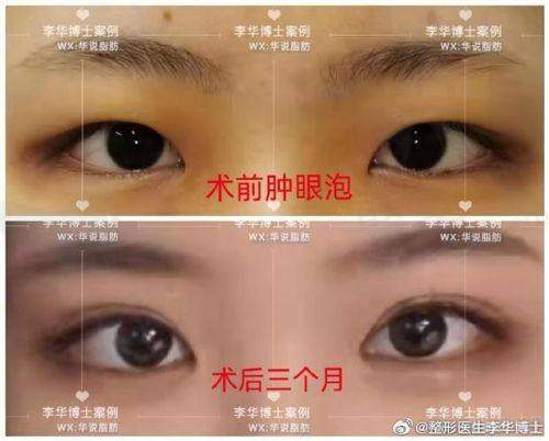 三、何玮医生修复双眼皮的成功实例