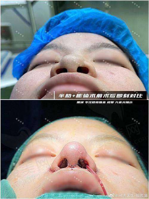 二、佛山鼻整形收费贵吗？