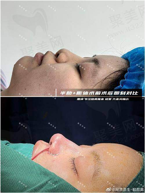 六、佛山鼻整形口碑实例