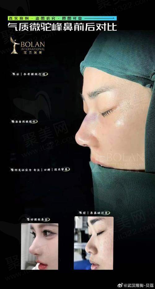 1. 佛山莘复健医疗美容医院鼻整形项目价格表