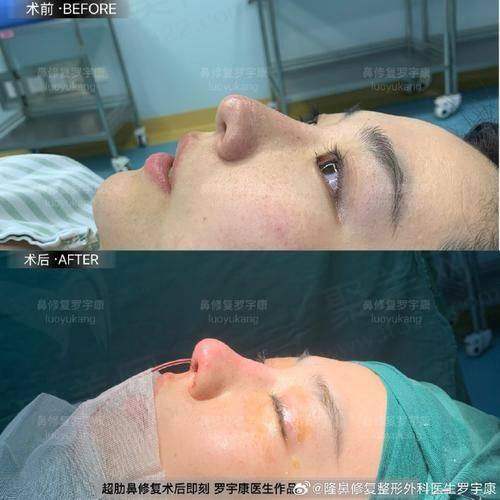 一、佛山鼻子整形手术价格表总览