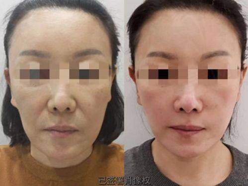 一、长沙地区面部轮廓整形价格表总览
