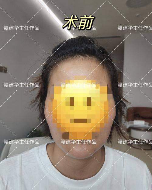 患者对肖林医生下颌角截骨手术的真实口碑评价