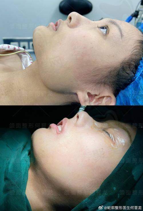 肖林医生做下颌角截骨项目的具体优势