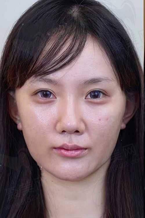 北京做热玛吉好的国有医院