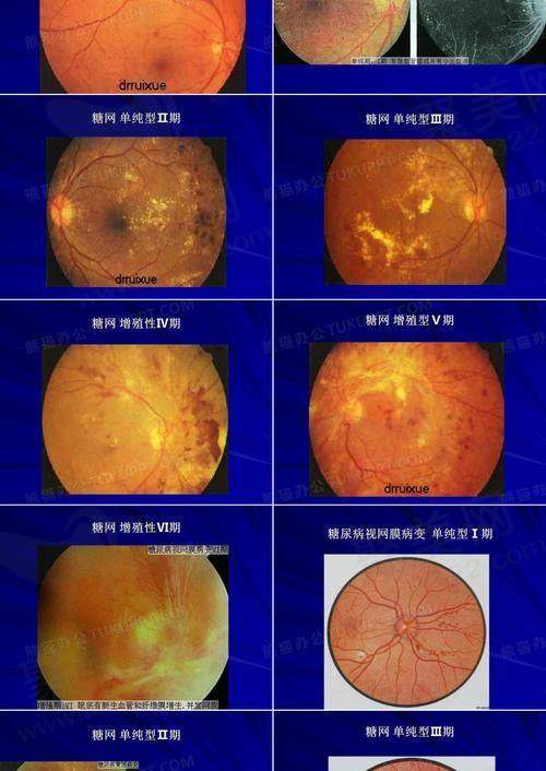 北京熙仁眼科医院黄瑶医生做后巩膜加固术怎么样？