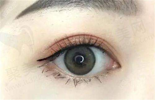 广州米伦整形切开重睑术：打造自然灵动双眼
