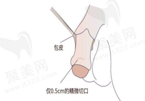 吕方中医生双眼皮手术的优势有哪些？