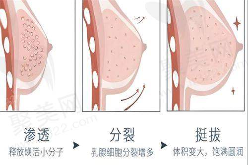 重庆艺星朱家旭法国优丝俪假体丰胸87950元起，选择优质假体，打造自然美胸体验