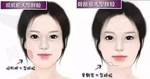 不同双眼皮手术方式价格有何差异？