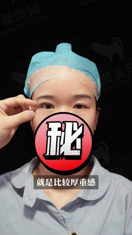 三、成都黄小林双眼皮修复技术优势