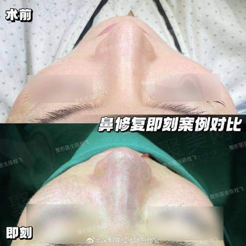 2、广州美莱医院鼻部整形价格表