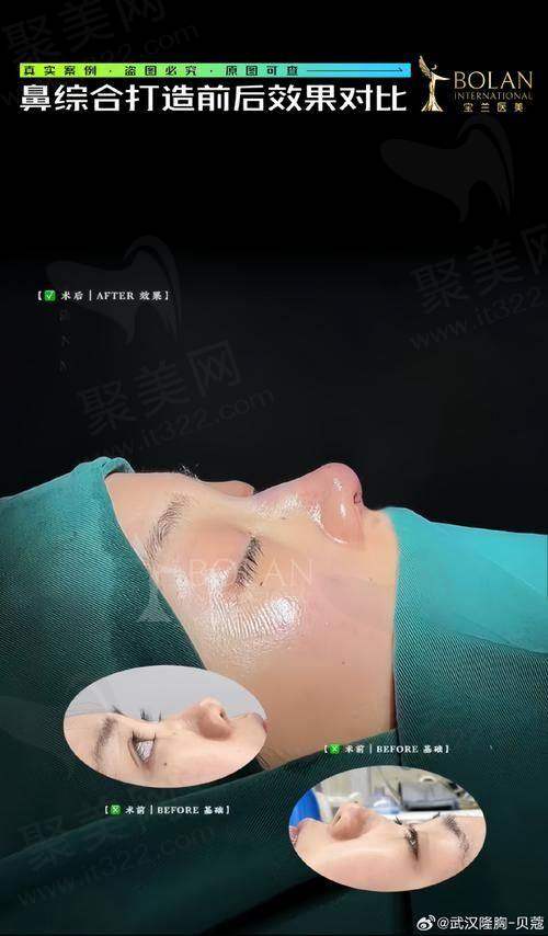 5、广州鼻部整形术后护理费用明细