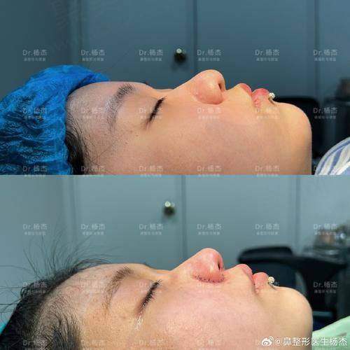 3、广州非手术隆鼻价格表