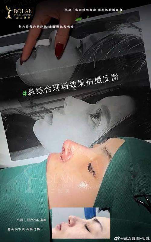 1、广州华美医院鼻部整形价格表