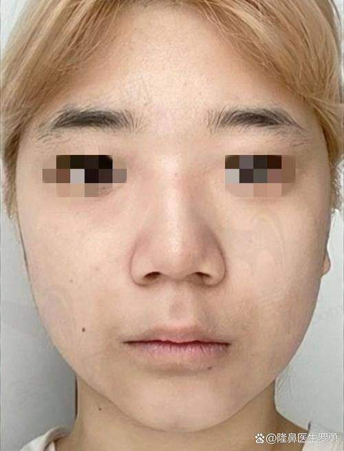 四、深圳李俊医生隆鼻的真实评价