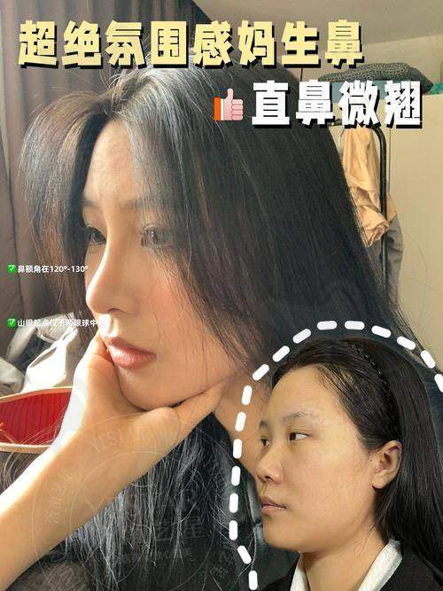 四、深圳徐荣阳鼻整形：价格与影响因素