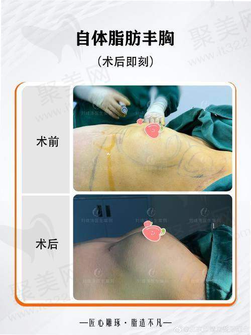 重庆艺星朱家旭法国优丝俪假体的技术特点