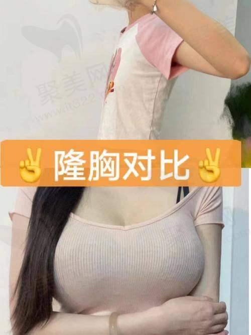 重庆艺星朱家旭丰胸手术的价格分析