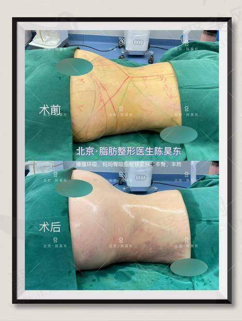 五、王阳吸脂价格情况