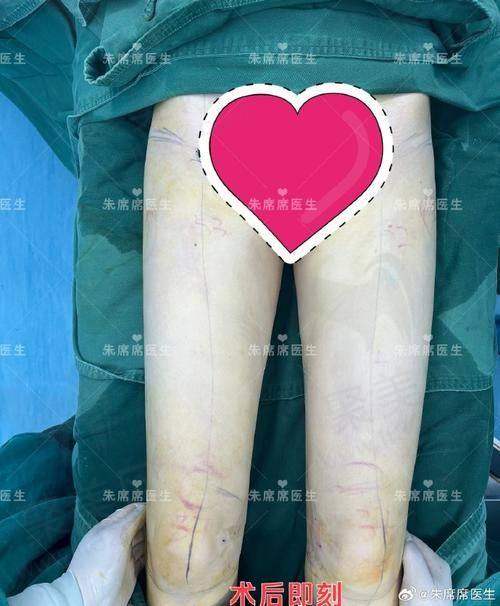 二、武汉王彬医生 37°柔性腰腹吸脂技术特点