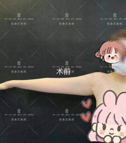 六、北京王阳吸脂的一些注意事项