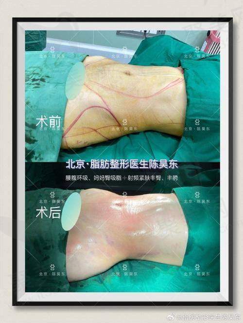 五、适合吸脂的人群
