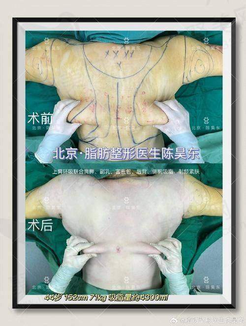 三、武汉王彬医生吸脂手术优势
