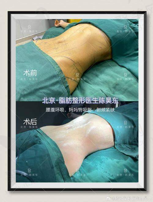 三、田其医生吸脂技术特点解析