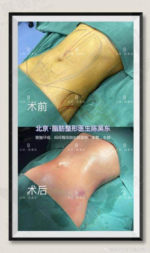 五、预约蒲小兵院长抽脂手术流程