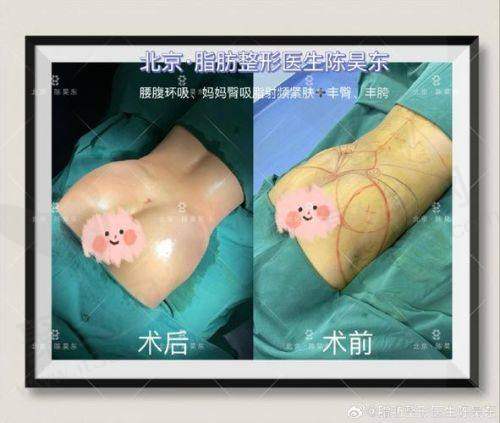 二、北京王阳医生擅长的吸脂技术及优势